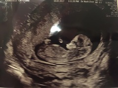 12 week scan- gender