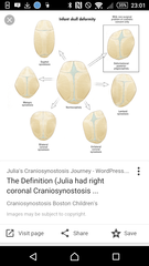 I will try again...Microchephaly