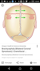 I will try again...Microchephaly