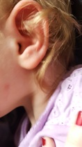 Is this ChickenPox? Pics incuded
