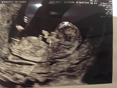 12 week scan- gender