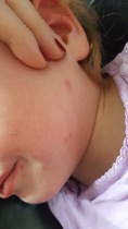 Is this ChickenPox? Pics incuded