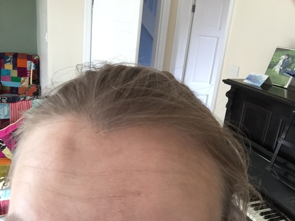 To show you this dent in my head that's appeared overnight (pic included)?