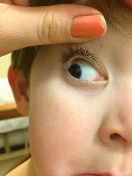 Toddler eyeball