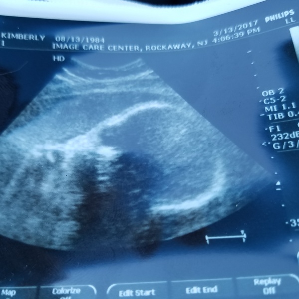 ultrasound