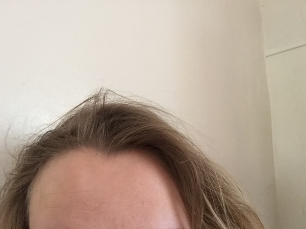 To show you this dent in my head that's appeared overnight (pic included)?