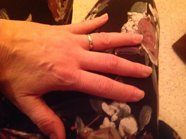 Guess the age of my hand.