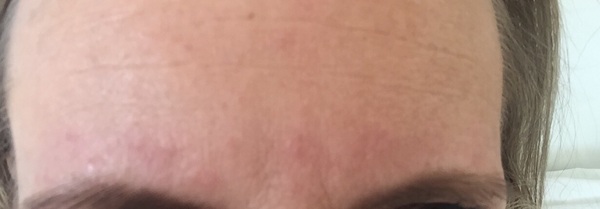 Help! Brow wax reaction