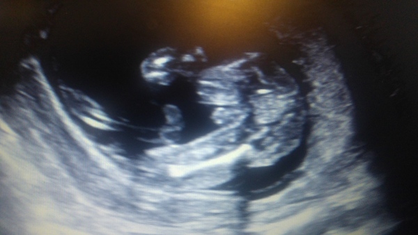 16wk gender scan