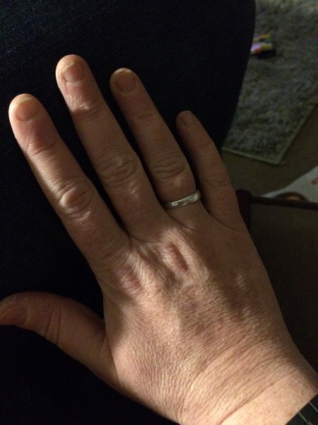 Guess the age of my hand.