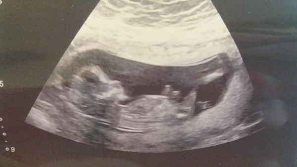 October Babies No. 3