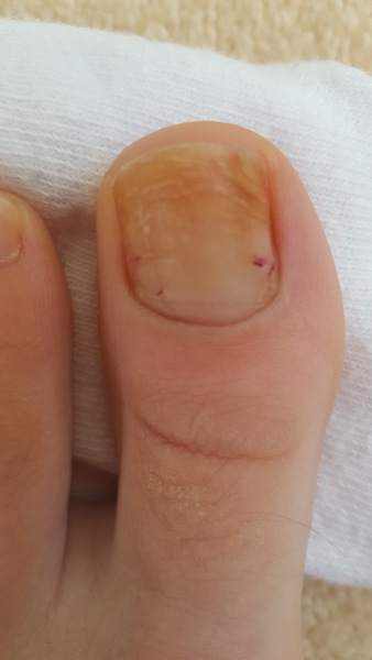 Pedicure my ugly toenail