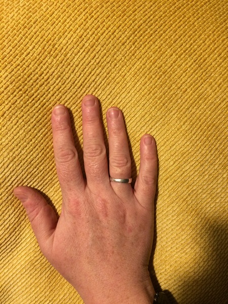 Guess the age of my hand.