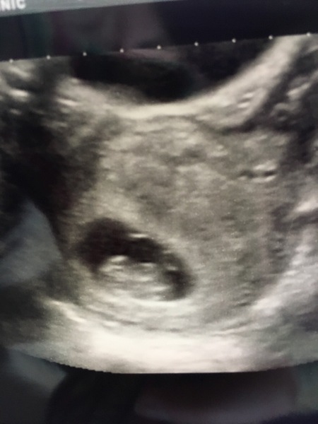 First scan this pregnancy  ramzi threory