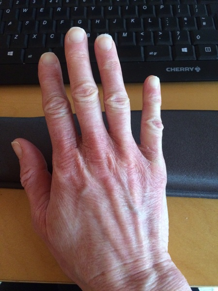 Guess the age of my hand.