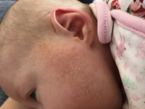 Advice needed - dry skin on 12 week old's face