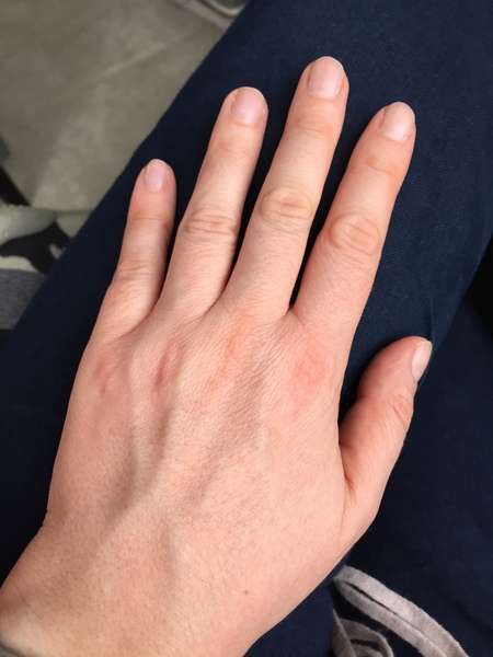 Guess the age of my hand.