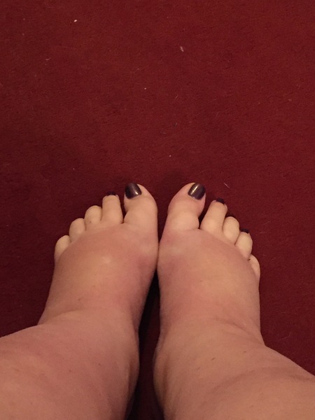 Hyperemesis Support