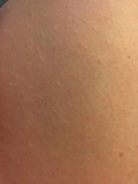 What are these bumps on my skin (pic)
