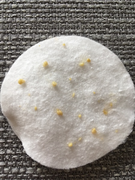 My tonsils are disgusting (pic)