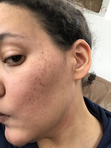 Skincare recommendations to help clear acne pigmentation