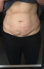 Is this fat or lose skin on my stomach (pic included)