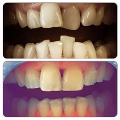 Adult orthodontics on NHS or Invisalign