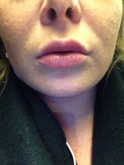 Lip fillers...your experiences