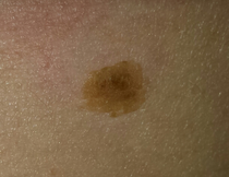 Anyone good with skin disorders?