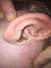 Daughters ear