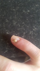 Klaxon - infected finger.
