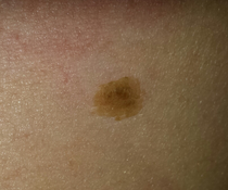 Anyone good with skin disorders?