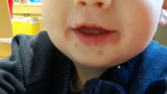 What is this rash on ds?