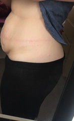Is this fat or lose skin on my stomach (pic included)