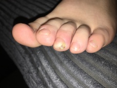 What is this on my sons toe????