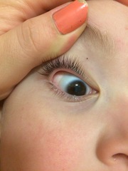 Toddler eyeball