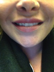 Lip fillers...your experiences