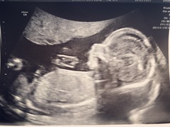 Baby Scan Photo Thread