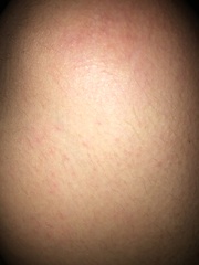 What are these bumps on my skin (pic)