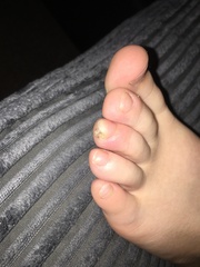 What is this on my sons toe????