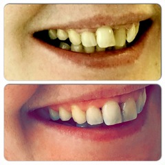 Adult orthodontics on NHS or Invisalign