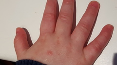 What is this rash on ds?