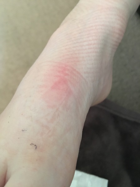 **pic warning** verruca infected?