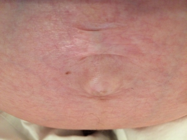 Worried skin is going to rip