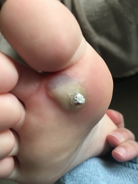 **pic warning** verruca infected?