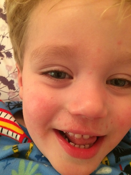 Spots in toddler from a cold? (Pic)