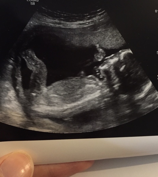 Problems at 20 week scan