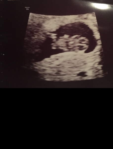 Early Scans: What did you see? (8+4)
