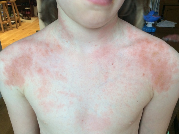 Rash getting worse...allergy? Eczema? Virus? Photo to help!