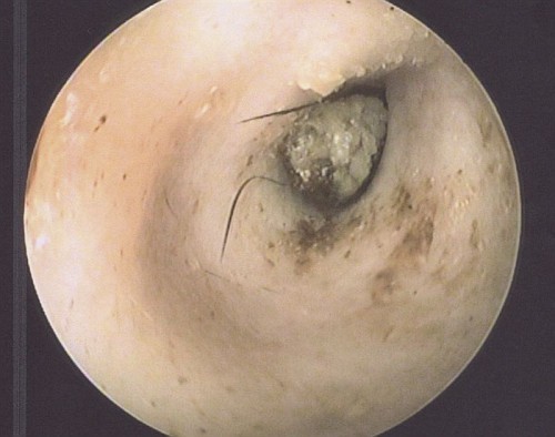 Anyone with experience of ear tumours?